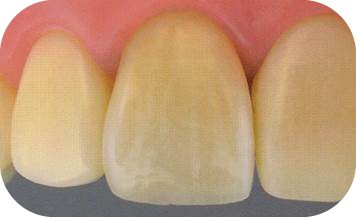 マツオデンタルクリニック(前歯)