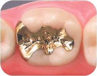 マツオデンタルクリニック(インレー)